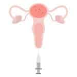 Illustrazione inseminazione intrauterina IUI