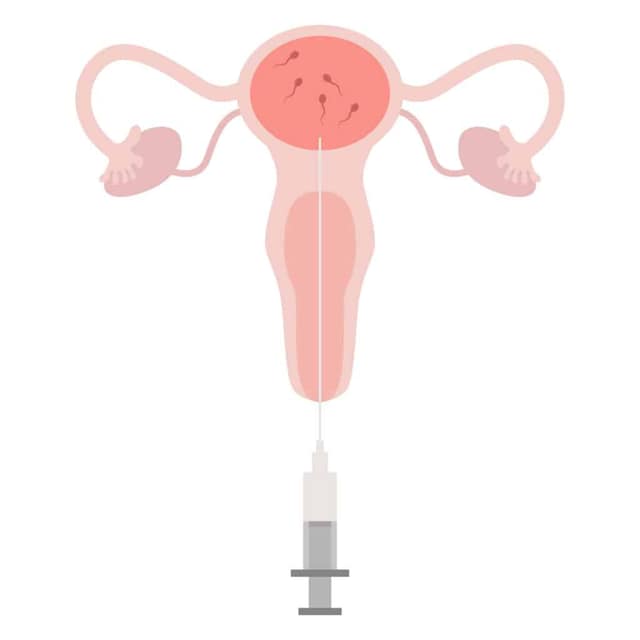 Illustrazione inseminazione intrauterina IUI