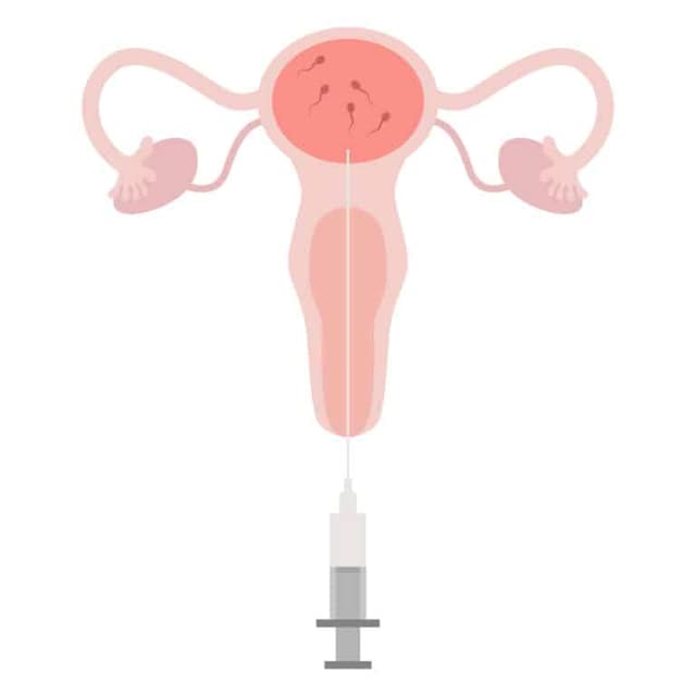 Illustrazione inseminazione intrauterina IUI
