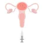 Illustrazione inseminazione intrauterina IUI